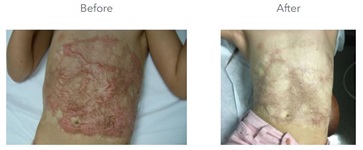 Before and After burnt patient treatment