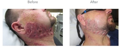 Before and After burnt patient treatment