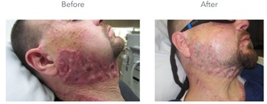 cigarette burn scar removal Laser therapy smooths and flattens raised scars after injury or surgery | Discovery Cigarette Burn Scar Reconstruction with