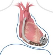 Left Ventricle Assist Device