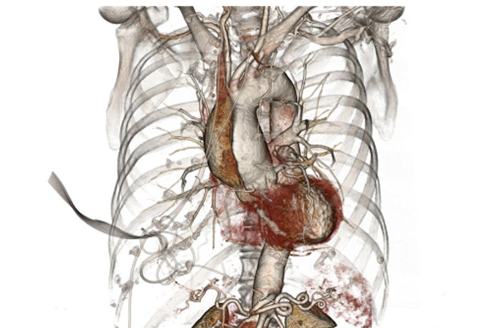 An anatomical image of a dissected aorta in a human heart.