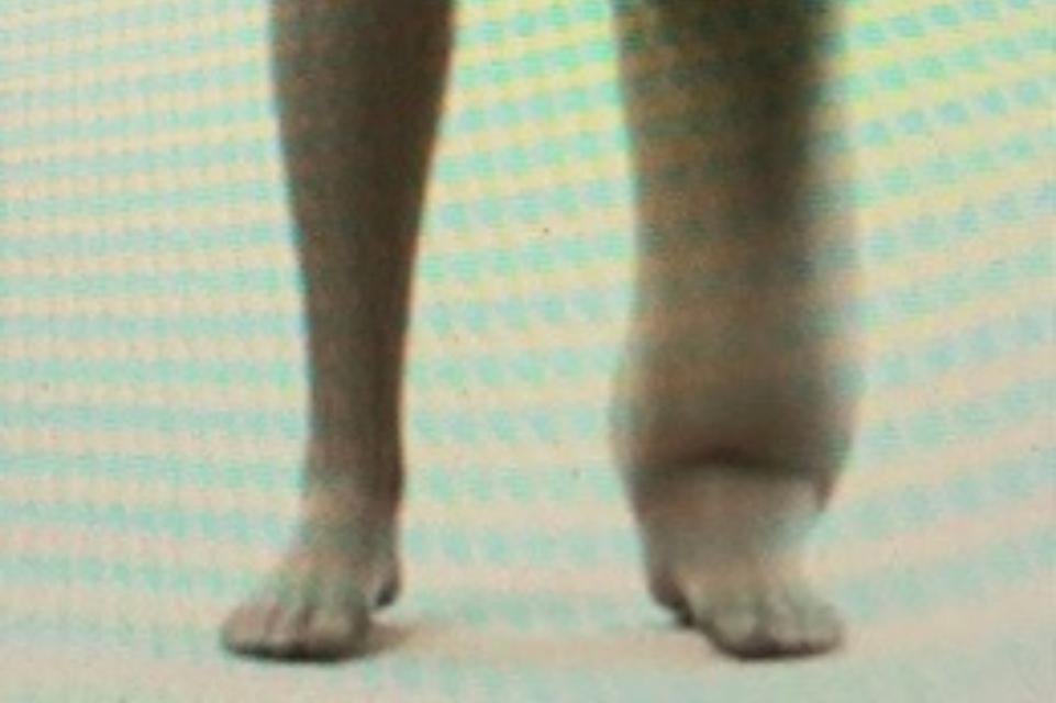 a picture of one leg treated for lymphedema and the other leg not treated