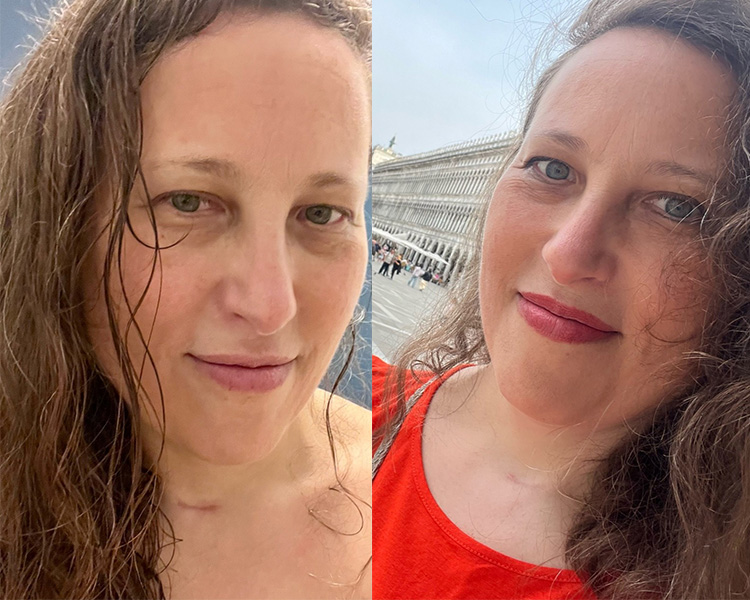 Before-and-after photos of Mercedes Marmorek following successful parathyroid surgery through Tampa General Hospital's Global Medicine Program, showing recovery after treatment for primary hyperparathyroidism.