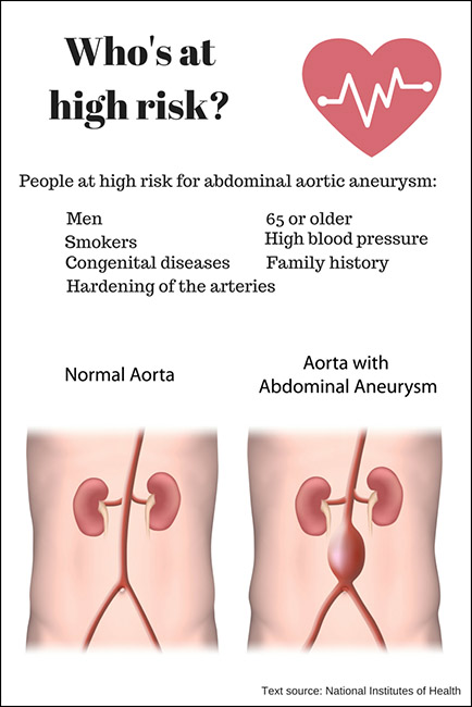 Infographic about risk factors for abdominal aortic aneurysm