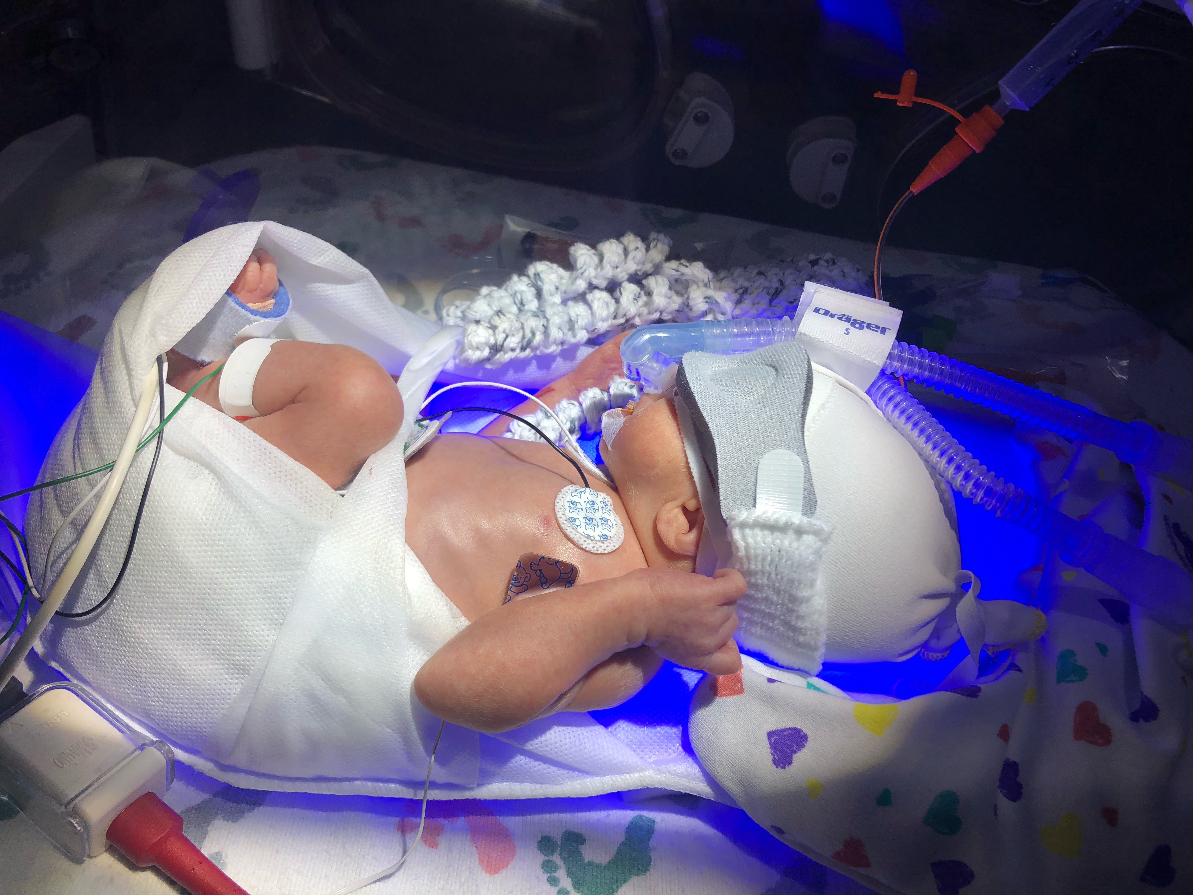 baby in the neonatal intensive care unit at TGH