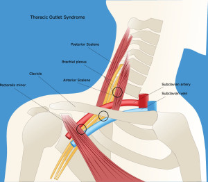 Diagram describing the parts of the neck and shoulders affected by thoracic outlet syndrome