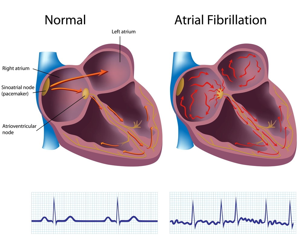 What is Atrial Fibrillation (AFib)? | Tampa General Hospital